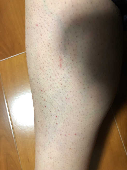 家庭用レーザー脱毛器トリアの効果検証 すね毛1回目 ムダ毛処理委員会