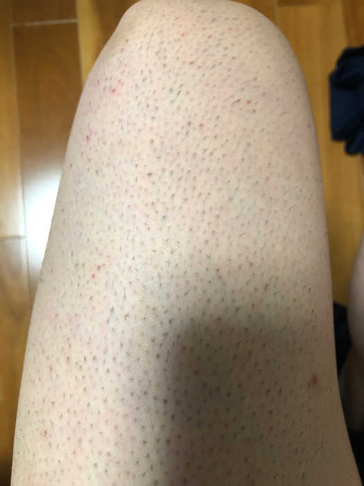 家庭用レーザー脱毛器トリアの効果検証 -太もも1回目- | ムダ毛 ...