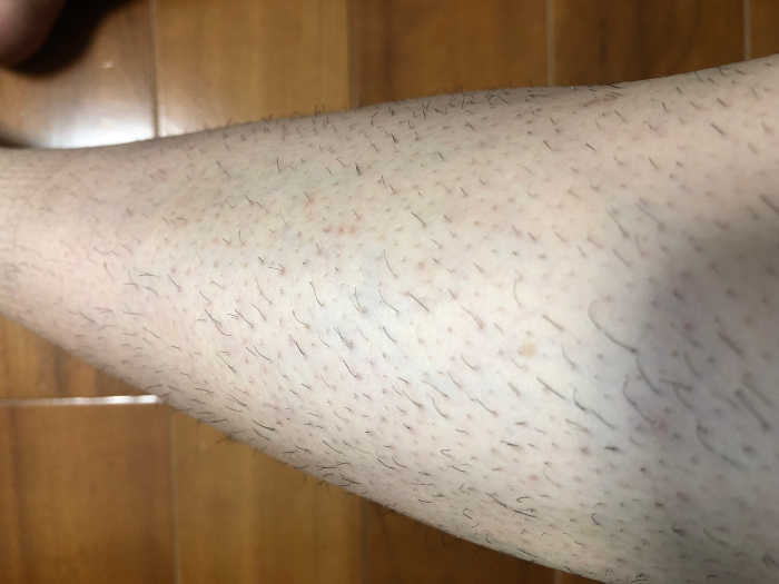 家庭用レーザー脱毛器トリアの効果検証 -すね毛編その3 ...