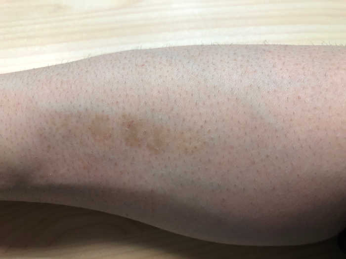 家庭用レーザー脱毛器トリアの効果検証 -腕毛5回目- | ムダ毛 ...